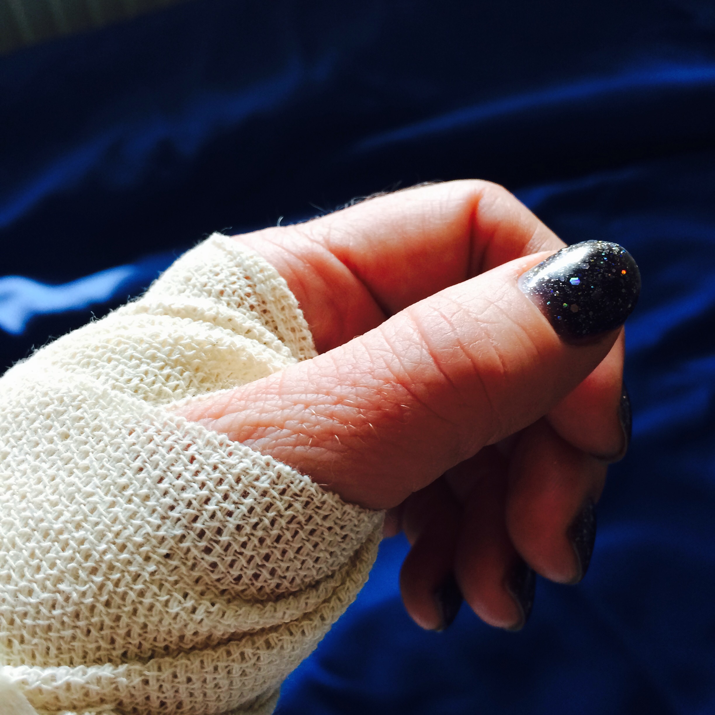 Hand i bandage med svartglittrigt nagellack på tummen.